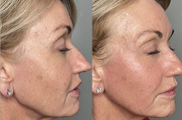 شد الجلد وتحديده في الرياض