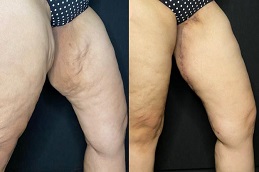 شد الفخذين في الرياض والمملكة العربية السعودية