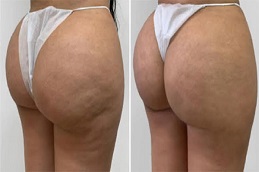 شد المؤخرة بدون جراحة في الرياض والمملكة العربية السعودية