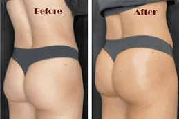 شد المؤخرة بدون جراحة في الرياض