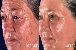 شد الوجه بالخلايا الجذعية في الرياض