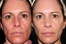 شد الوجه بالخلايا الجذعية في الرياض والمملكة العربية السعودية