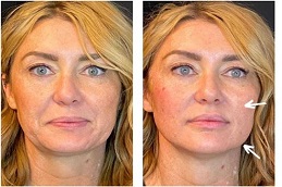 شد الوجه بالخيوط الناعمة بتقنية سيلويت في الرياض والمملكة العربية السعودية