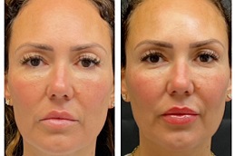 شد الوجه بالخيوط الناعمة بتقنية سيلويت في الرياض