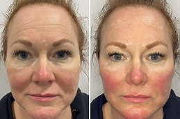 شد الوجه بثمانية نقاط باستخدام جوفيديرم في الرياض والمملكة العربية السعودية