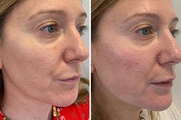 شد الوجه بثمانية نقاط باستخدام جوفيديرم في الرياض