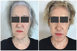 شد الوجه بدون جراحة في الرياض والمملكة العربية السعودية