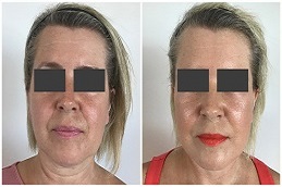 شد الوجه بدون جراحة في الرياض