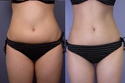 شفط الدهون بالليزر بتقنية GPS في الرياض والمملكة العربية السعودية