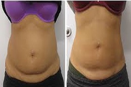 شفط الدهون بالليزر بتقنية GPS في الرياض