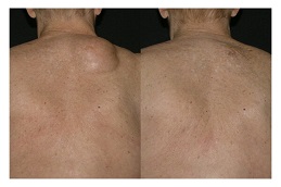 علاج الأورام الشحمية في الرياض والمملكة العربية السعودية