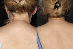 علاج الأورام الشحمية في الرياض