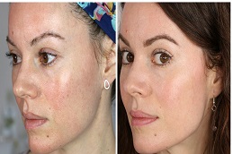 علاج الإبر الدقيقة في الرياض والمملكة العربية السعودية