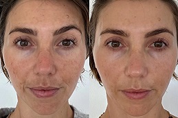 علاج الإبر الدقيقة في الرياض