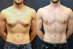 علاج التثدي في الرياض والمملكة العربية السعودية