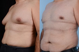 علاج التثدي في الرياض