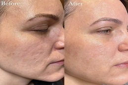 علاج الترددات الراديوية في الرياض والمملكة العربية السعودية