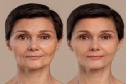 علاج الترددات الراديوية في الرياض