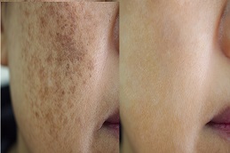 علاج التصبغات الجلدية في الرياض