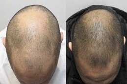 علاج الخلايا الصبغية في الرياض والمملكة العربية السعودية