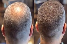 علاج الخلايا الصبغية في الرياض