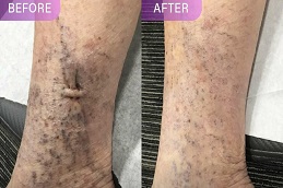 علاج الدوالي العنكبوتية في الرياض