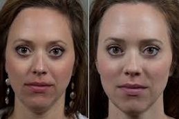 علاج الفراكشنال ليزر مع البلازما الغنية بالصفائح الدموية في الرياض والمملكة العربية السعودية