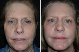 علاج الفراكشنال ليزر مع البلازما الغنية بالصفائح الدموية في الرياض والمملكة العربية السعودية