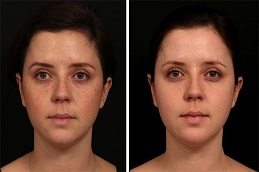 علاج الفراكشنال ليزر مع البلازما الغنية بالصفائح الدموية في الرياض