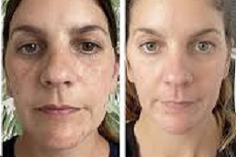 علاج الكلف في الرياض والمملكة العربية السعودية