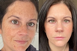 علاج الكلف في الرياض