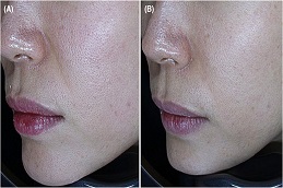 علاج المسامات الواسعة في الرياض والمملكة العربية السعودية