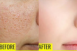 علاج المسامات الواسعة في الرياض