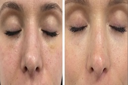 علاج الميزوثيرابي في الرياض والمملكة العربية السعودية