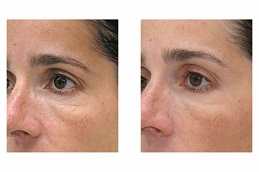 علاج الميزوثيرابي في الرياض