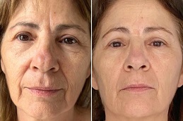 علاج الهايفو في الرياض والمملكة العربية السعودية