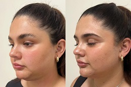 علاج الهايفو في الرياض