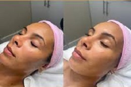 علاج الوجه بالأكسجين في الرياض والمملكة العربية السعودية