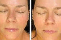 علاج الوجه بالأكسجين في الرياض