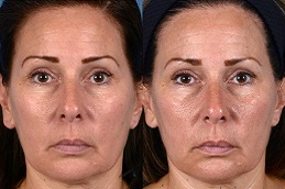 علاج الوجه بالليزر في الرياض والمملكة العربية السعودية