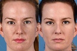 علاج الوجه بالليزر في الرياض