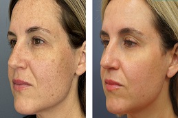 علاج الوجه في الرياض والمملكة العربية السعودية