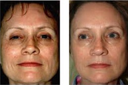 علاج الوخز بالإبر في الرياض والمملكة العربية السعودية