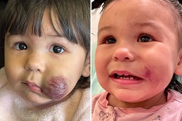 علاج الورم الوعائي الدموي في الرياض والمملكة العربية السعودية