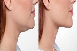 علاج بيلكيرا في الرياض والمملكة العربية السعودية