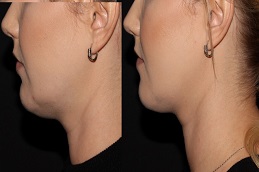 علاج بيلكيرا في الرياض