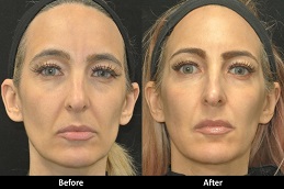 علاج تجديد شباب الوجه في الرياض والمملكة العربية السعودية