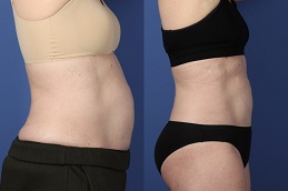 علاج تجميد الدهون بتقنية كول سكلبتينج في الرياض والمملكة العربية السعودية