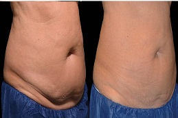 علاج تجميد الدهون بتقنية كول سكلبتينج في الرياض