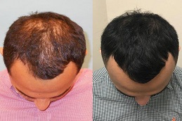 علاج تساقط الشعر بتقنية ACell PRP في الرياض